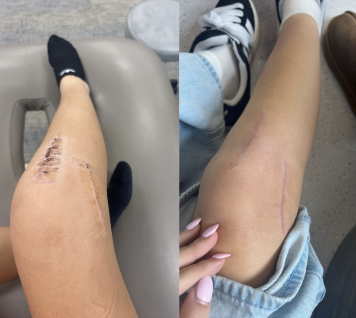 Adalyn Armstrong-Cattani's (11) scar right after surgery and a month after surgery.